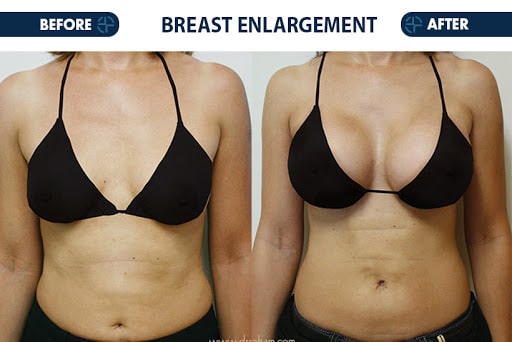 breast-enlargement